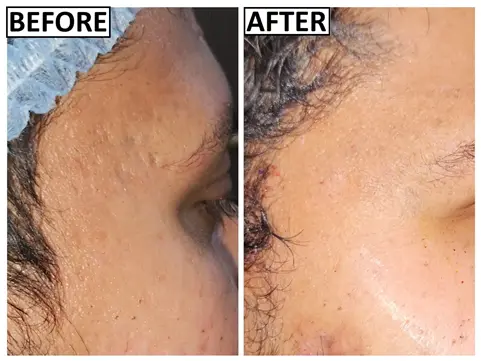 Before and after acne scar treatment by Dr. Amrika Seshadri